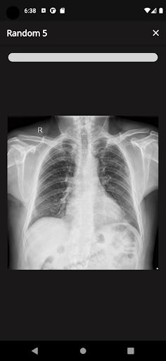 X-Ray Flashcards Tuberculosis Screen 3