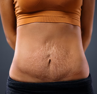 How to Get Rid of Stretch Mark