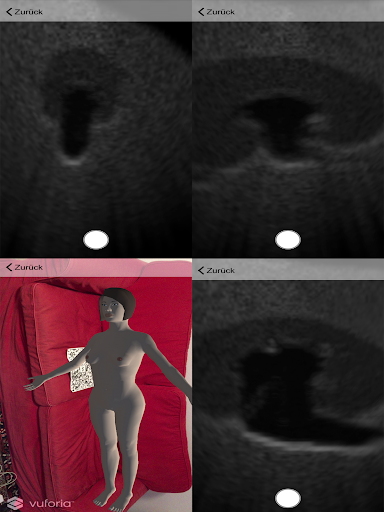 augmented reality ultrasound s