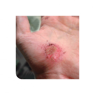 Abrasions Natural Home Remedy apk