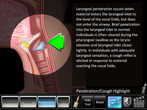 Swallowing Aspiration Screen 2