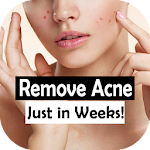 Cover Image of Tải xuống Remove Facial Acne Tips 1.0 APK
