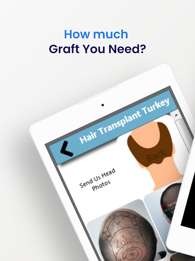 Hair Transplant Turkey - Graft