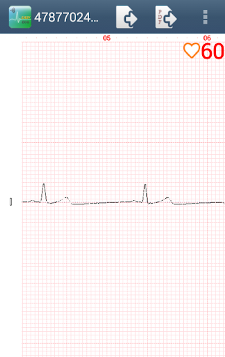 Easy ECG Mobile Light Screen 2