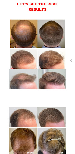 Download HAIR LOSS GUIDE FOR MEN for Android - HAIR LOSS GUIDE FOR MEN APK  Download 