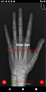 Bone Age Unknown