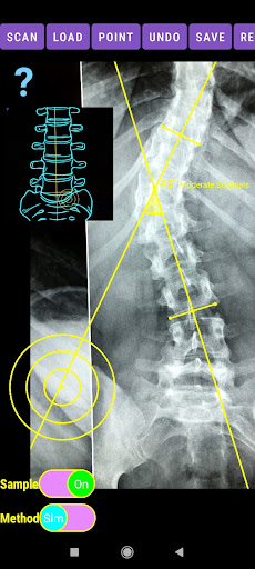 Cobb Angle App Screen 3