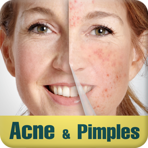 Acne & Pimples 1.0 Icon