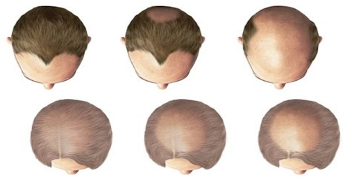 7 Ways to get or growth hair back.