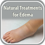 Natural Treatments for Edema