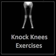 Knock Knees Exercises