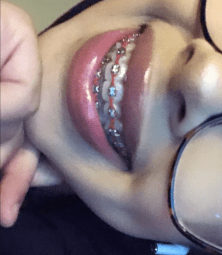 Dental Braces Screen 3