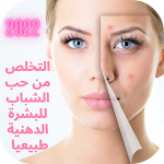 Cover Image of Download التخلص من حب الشباب بدون نت  APK