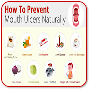 Prevent Mouth Ulcer Nature
