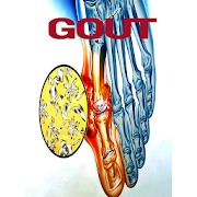 Gout Disease