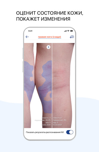 Atopic App – AI Eczema Manager Screen 2