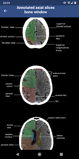 Brain CT : annotated slices Screen 3