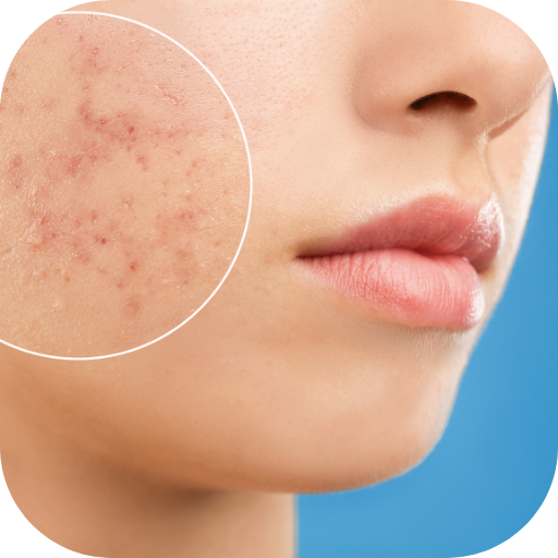 fungal acne treatment Download on Windows