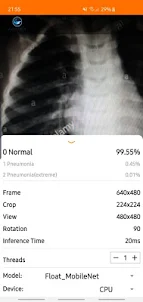 Chest X-Ray Classifier
