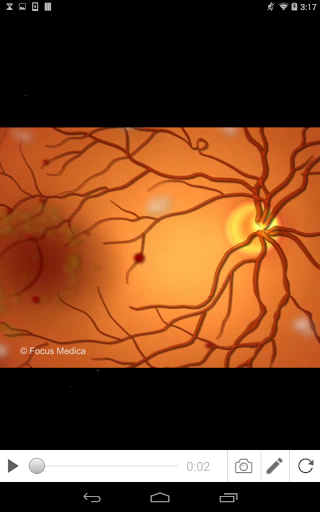 Diabetic Retinopathy Screen 3