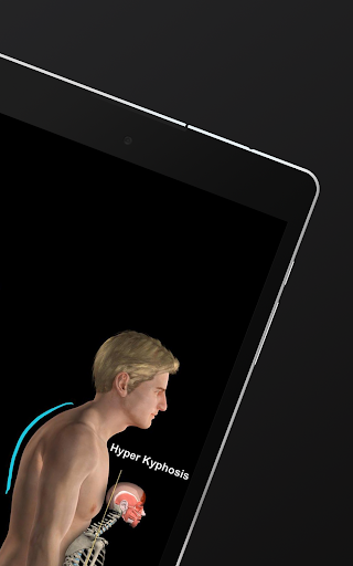 Screenshot of Kyphosis & Rounded Back by M&M