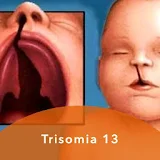 Trisomia 13 icon