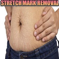Natural Stretch Marks Removal
