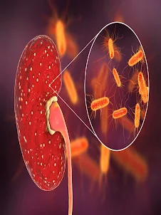Pyelonephritis Kidney Disease