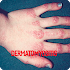 Dermatophytosis Infection1.0.0
