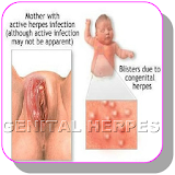 Home remedies for Genital herpes infection icon