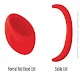 Sickle Cell Anemia Download on Windows
