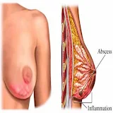 Breast mastitis and treatment icon