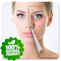 Skin Treatment - Get Rid Of Acne And Pimples Natur