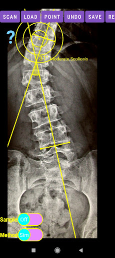 Cobb Angle App screenshot 11