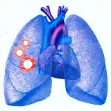 Pulmonary Nodule Fleischner icon