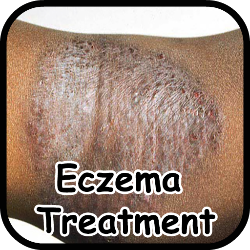 Eczema Symptoms Treatment
