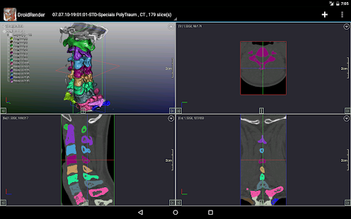 DroidRender - 3D DICOM viewer  Screenshots 14