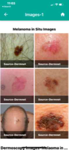 Android application Skin cancer Scoring App screenshort
