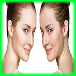 Cover Image of Herunterladen Acne Treatment-Sensitive Skin  APK