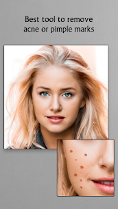 Remove Acne from Face 2