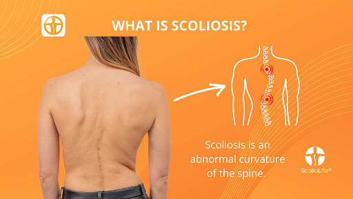 Scoliometer App screenshot 17