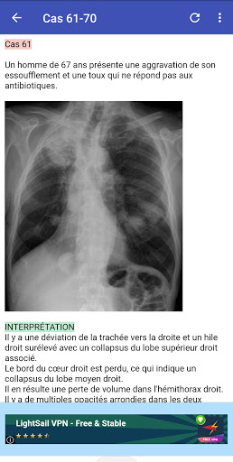 Cas cliniques radio thorax
