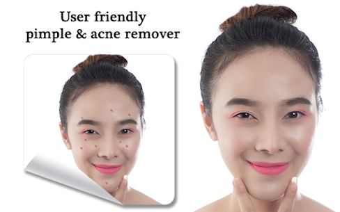Pimple Remover, Eraser – Face Beauty Maker 4