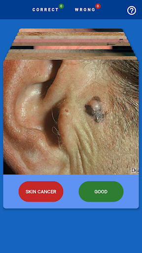 MelanomaExam Screen 2
