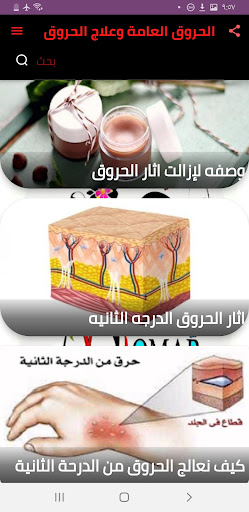 الحروق العامه وعلاجها  بلكامل