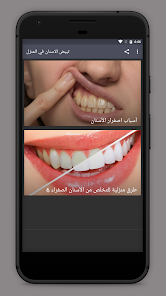Teeth whitening at home 2.0.0 APK + Mod (Unlimited money) untuk android