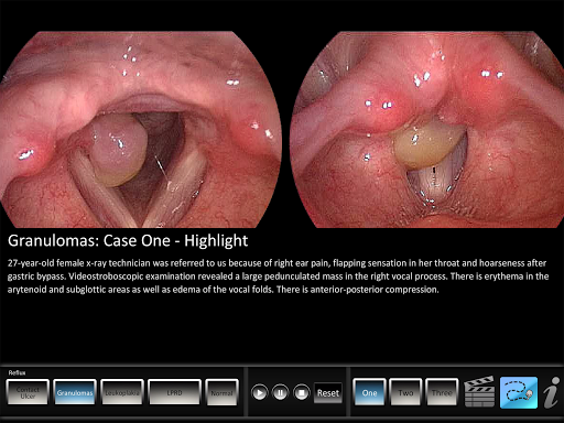 Reflux Screen 2