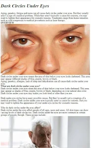 How To Remedie Dark Circle Eye