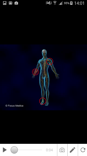 Neuropathic Pain Screen 3