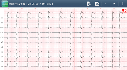 Easy ECG Mobile PRO Screen 2